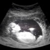 Ultraschall in der Schwangerschaft unbedenklich